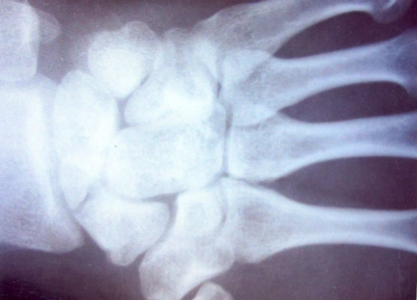 рентгенограмма кисти больного при поступлении