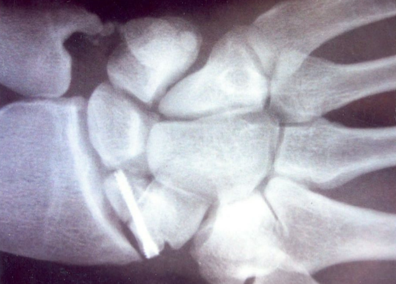 Рентгенограмма кисти больного через 2 мес. после операции