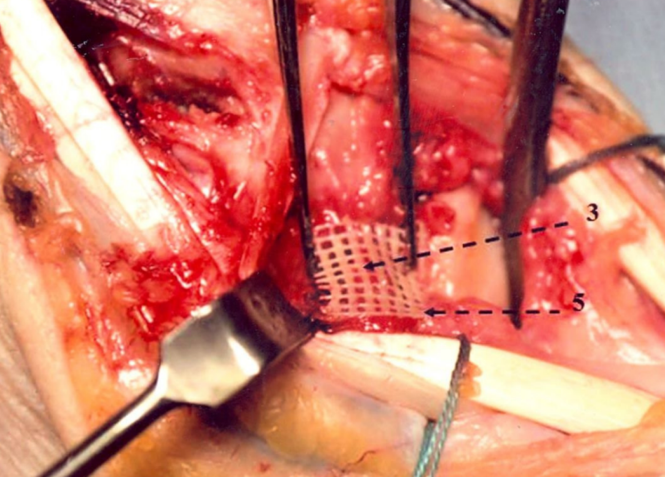 Фиксация костного трансплантата сеткой Викрил и клеем для переломов